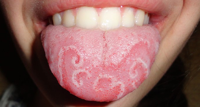 geographic tongue