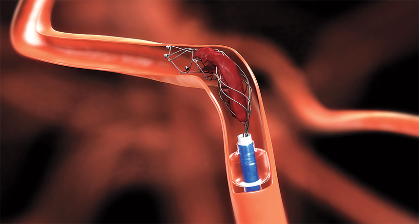 opening brain vessel