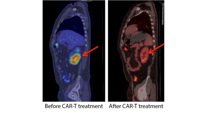 CAR-T therapy