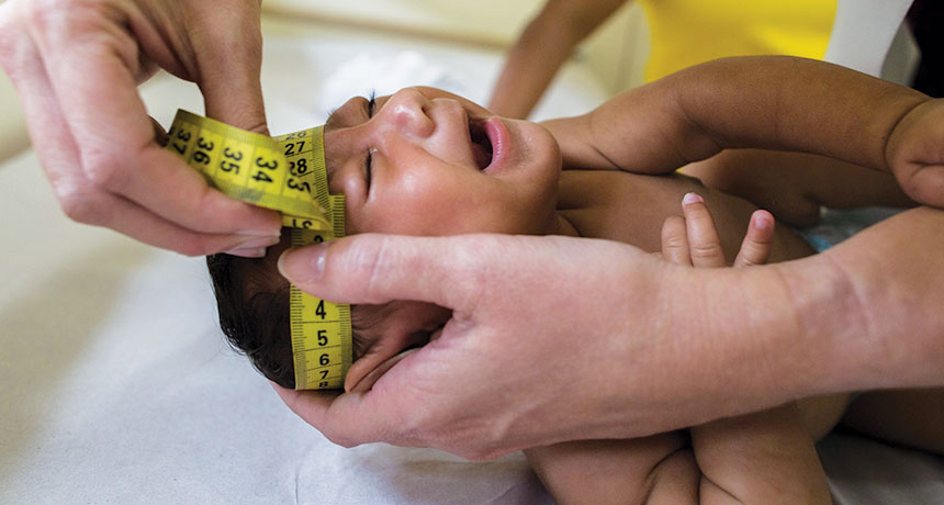 baby with microcephaly