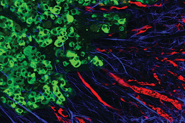 collagen fibers and cancer cells