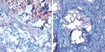 cancer tissues and stained sugars