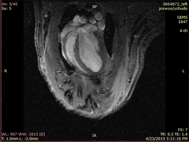 heart mri gif