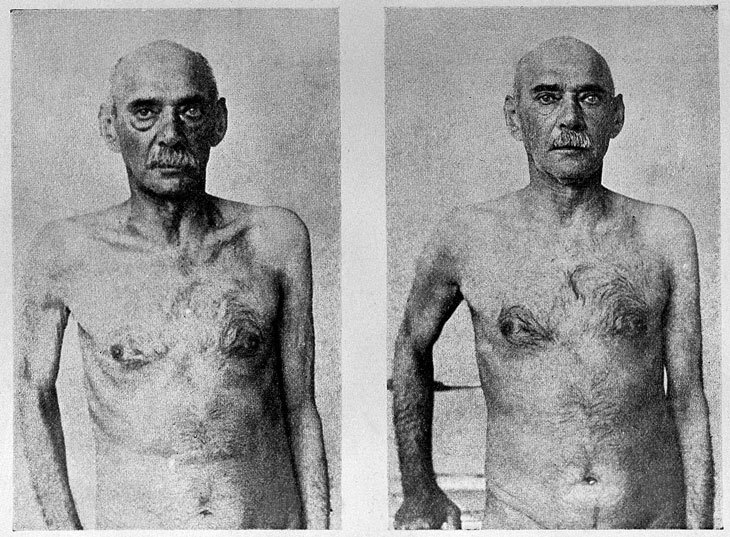 before-and-after photo of a 72-year-old man who had a vasectomy