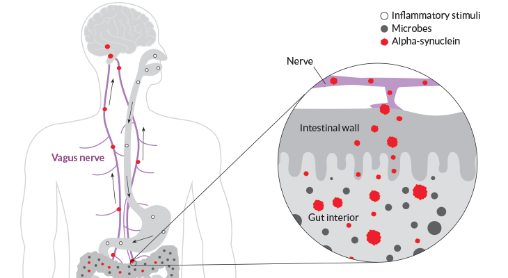 an illustration showing how an inflammatory reaction in the gut can cause nerve death in the brain