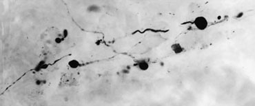 an image showing Lewy bodies (the black blobs)