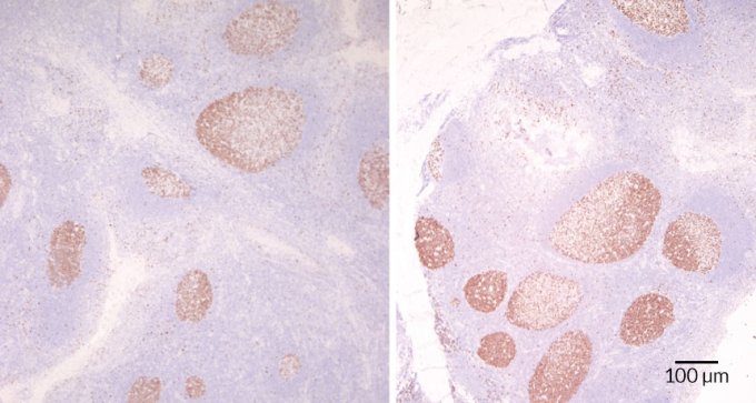 a microscopic image showing differences in immune structure in tonsils between kids with and without repeat strep throat infections