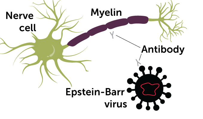 a diagram showing how the immune system attempts to attack the Epstein-barr virus cause attacks on the myelin sheath on nerve cells