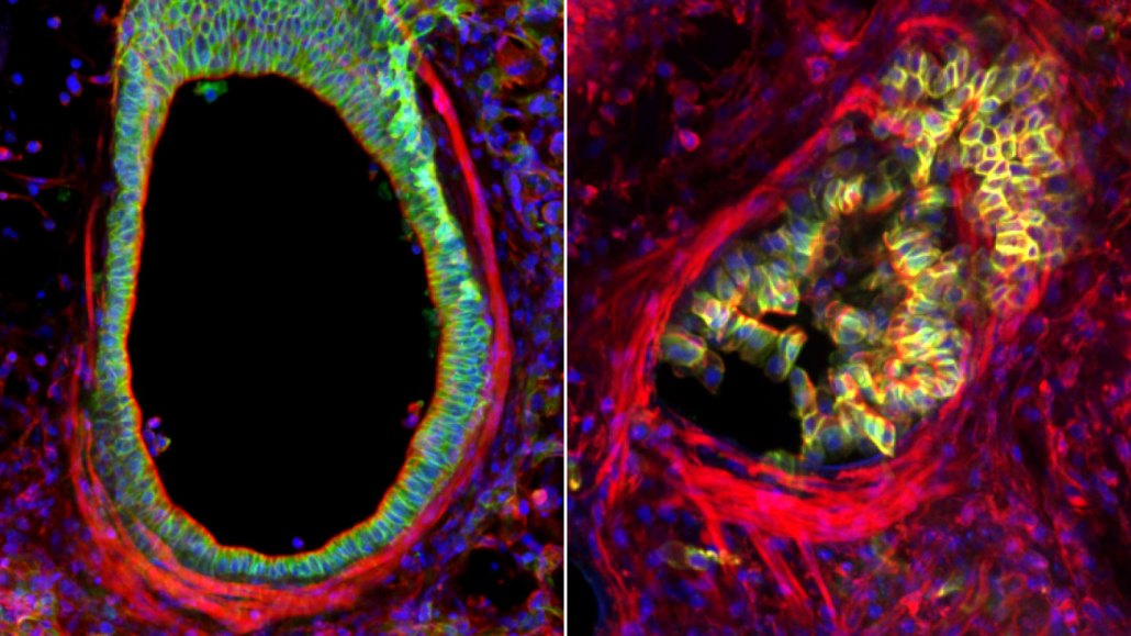 Two side-by-side images of a mouse's airway. In the one on the left, a ring of greenish tissue surrounds a black space, indicating the airway is open. On the right, that black area is filled with a chaotic mass of that tissue (now appearing greenish yellow), showing how the cells lining the area can clog the airway and make it harder to breathe.