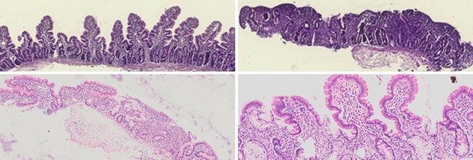 Four panels showing cross sections of the intestinal lining of children with malnutrition. In the upper left panel, purple colored finger-like extensions can be seen. The upper left panel has none of the fingers. The lower left is a pinkish slice of tissue with none of the fingers. Several pinkish fingers can be seen in the lower right panel.