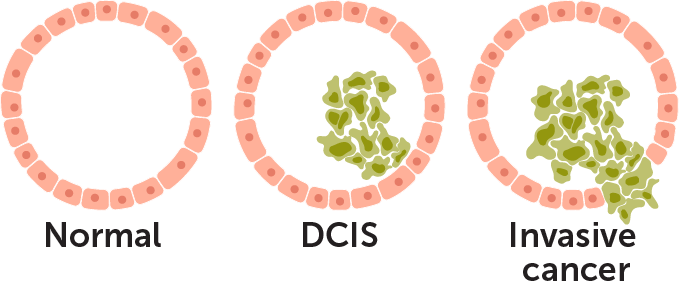 An illustration of the appearance of a normal breast duct (a pinkish circle of cells), a duct with DCIS (blobby brown cells growing inside the circle), and invasive cancer (the blobby brown cells broken through the circle).