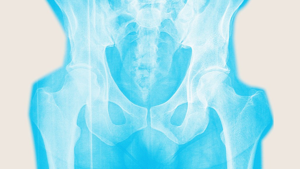 An illustration showing an X-ray of a pelvis.